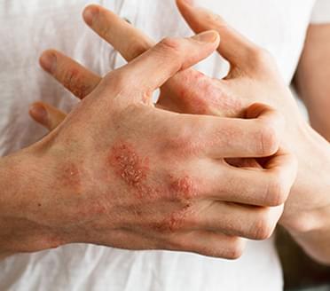 Rashes, eczema, pimples